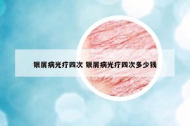 银屑病光疗四次 银屑病光疗四次多少钱