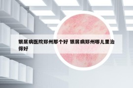 银屑病医院郑州那个好 银屑病郑州哪儿里治得好