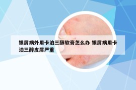 银屑病外用卡泊三醇软膏怎么办 银屑病用卡泊三醇皮屑严重