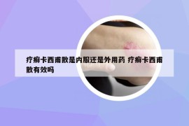 疗癣卡西甫散是内服还是外用药 疗癣卡西甫散有效吗