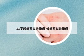 11岁起癣可以洗澡吗 长癣可以洗澡吗