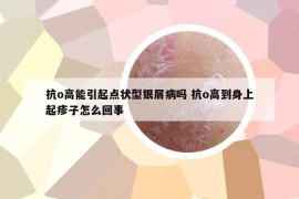 抗o高能引起点状型银屑病吗 抗o高到身上起疹子怎么回事