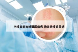 泡澡出能治好银屑病吗 泡浴治疗银屑病