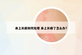 身上长藓如何处理 身上长癣了怎么办?