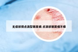 无症状得点滴型银屑病 点滴状银屑病不痒