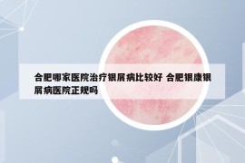 合肥哪家医院治疗银屑病比较好 合肥银康银屑病医院正规吗