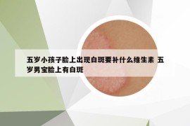 五岁小孩子脸上出现白斑要补什么维生素 五岁男宝脸上有白斑