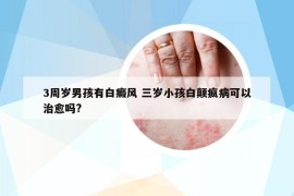 3周岁男孩有白癜风 三岁小孩白颠疯病可以治愈吗?