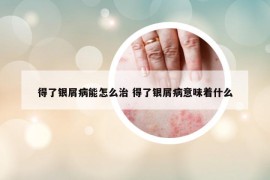 得了银屑病能怎么治 得了银屑病意味着什么