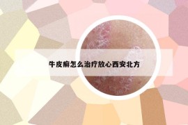 牛皮癣怎么治疗放心西安北方