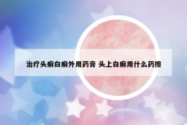 治疗头癣白癣外用药膏 头上白癣用什么药擦