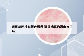 银屑病还没有新进展吗 银屑病真的没未来了吗