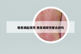 银屑病起硬壳 银屑病硬壳要去掉吗