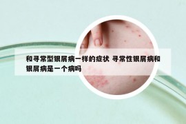 和寻常型银屑病一样的症状 寻常性银屑病和银屑病是一个病吗