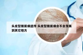 头皮型银屑病遗传 头皮型银屑病会不会发展到其它地方