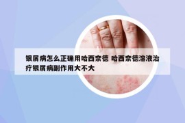 银屑病怎么正确用哈西奈德 哈西奈德溶液治疗银屑病副作用大不大