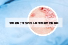 银屑病属于中医的什么病 银屑病的中医解释