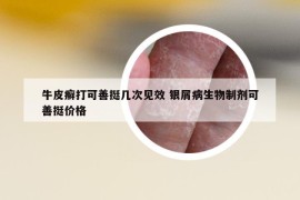 牛皮癣打可善挺几次见效 银屑病生物制剂可善挺价格