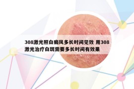 308激光照白癜风多长时间见效 用308激光治疗白斑需要多长时间有效果