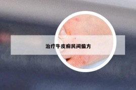 治疗牛皮癣民间偏方