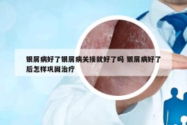 银屑病好了银屑病关接就好了吗 银屑病好了后怎样巩固治疗