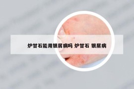 炉甘石能用银屑病吗 炉甘石 银屑病