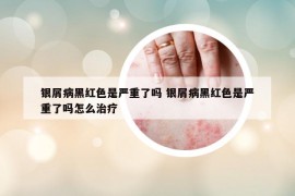 银屑病黑红色是严重了吗 银屑病黑红色是严重了吗怎么治疗