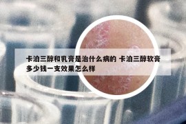 卡泊三醇和乳膏是治什么病的 卡泊三醇软膏多少钱一支效果怎么样