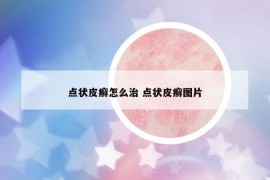 点状皮癣怎么治 点状皮癣图片