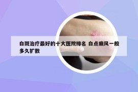 白斑治疗最好的十大医院排名 白点癫风一般多久扩散