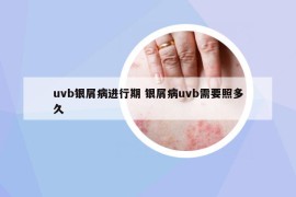 uvb银屑病进行期 银屑病uvb需要照多久