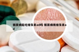 银屑病能吃维生素ad吗 银屑病用维生素ad