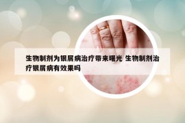 生物制剂为银屑病治疗带来曙光 生物制剂治疗银屑病有效果吗