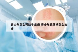 青少年怎么预防牛皮癣 青少年银屑病怎么治疗