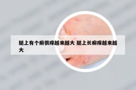 腿上有个癣很痒越来越大 腿上长癣痒越来越大