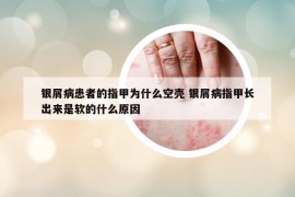 银屑病患者的指甲为什么空壳 银屑病指甲长出来是软的什么原因