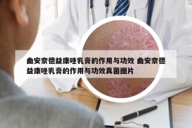 曲安奈德益康唑乳膏的作用与功效 曲安奈德益康唑乳膏的作用与功效真菌图片