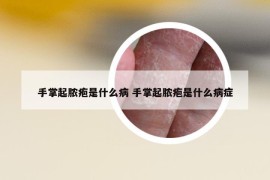 手掌起脓疱是什么病 手掌起脓疱是什么病症