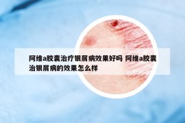 阿维a胶囊治疗银屑病效果好吗 阿维a胶囊治银屑病的效果怎么样