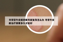 寻常型牛皮癣到春天就复发怎么办 寻常牛皮廨治疗需要多久才能好