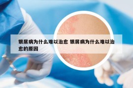 银屑病为什么难以治愈 银屑病为什么难以治愈的原因