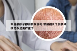 银屑病疹子都会有皮屑吗 银屑病长了很多红疹是不是更严重了