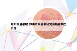 郑州银屑病吧 郑州市银屑病研究会所看病怎么样