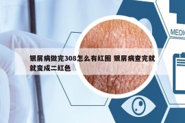 银屑病做完308怎么有红圈 银屑病查完就就变成二红色