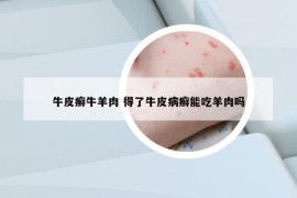 牛皮癣牛羊肉 得了牛皮病癣能吃羊肉吗