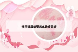 外阴银屑病要怎么治疗最好