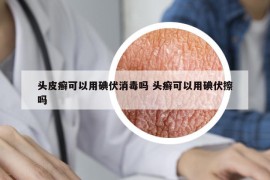 头皮癣可以用碘伏消毒吗 头癣可以用碘伏擦吗