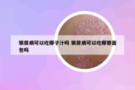 银屑病可以吃椰子汁吗 银屑病可以吃椰蓉面包吗