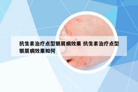 抗生素治疗点型银屑病效果 抗生素治疗点型银屑病效果如何