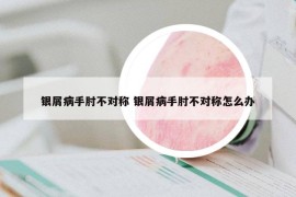 银屑病手肘不对称 银屑病手肘不对称怎么办